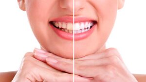 dentista blanqueamiento dental las tablas