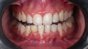 colocación dientes las tablas