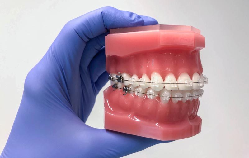 brackets dentilux