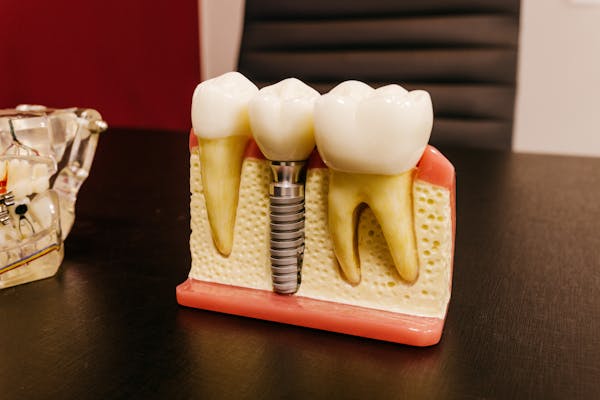 implantes dentales en las tablas madrid