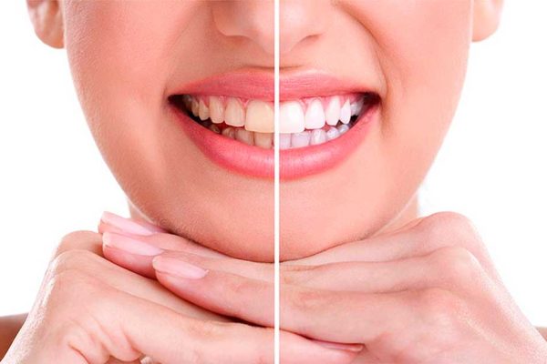 dentista blanqueamiento dental las tablas